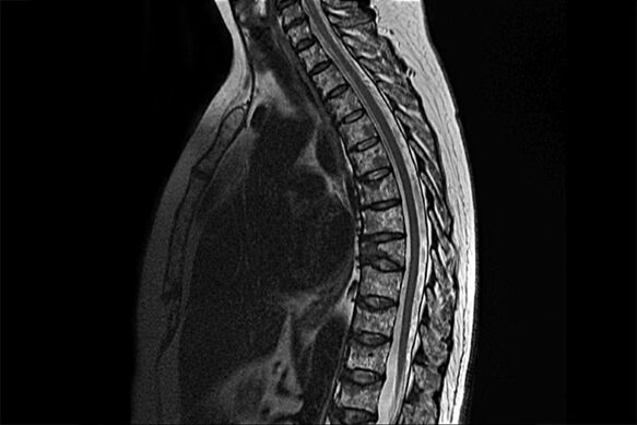 Prejavy hrudnej osteochondrózy na obraze MRI