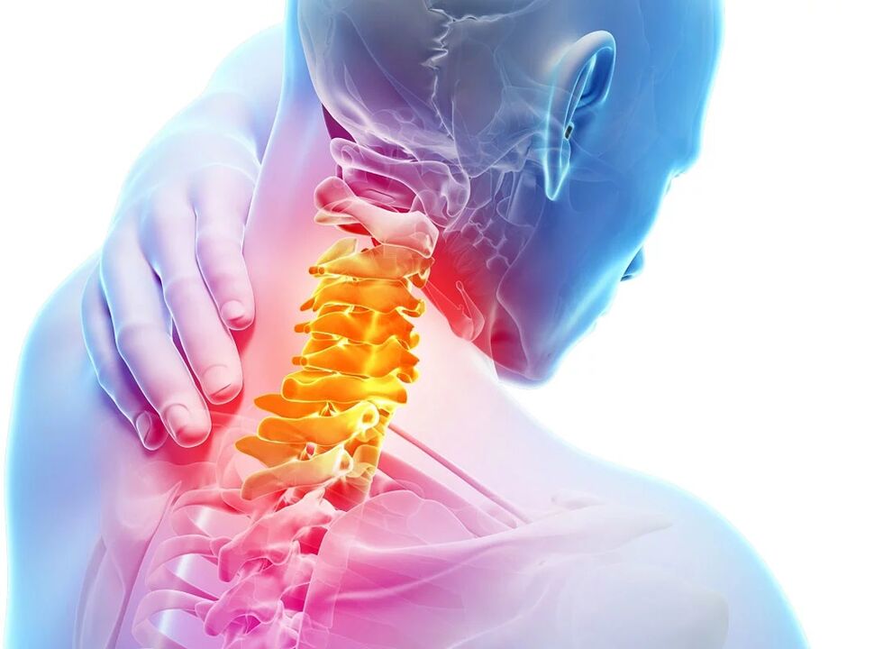 Cervikálna osteochondróza