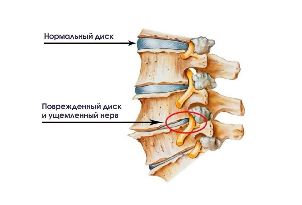 Príznaky krčnej osteochondrózy