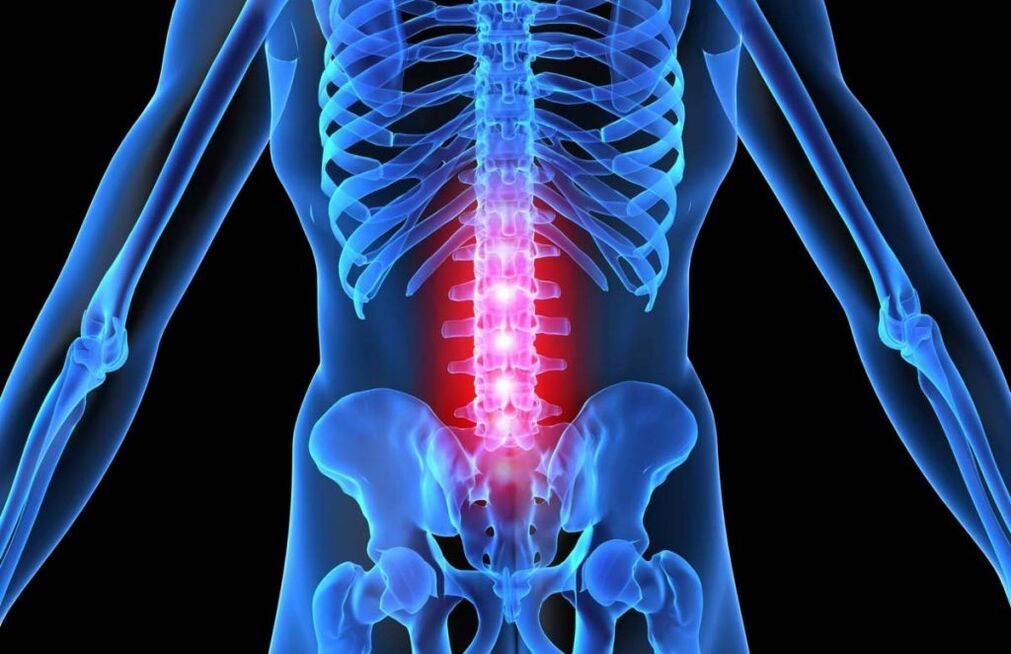 Osteochondróza bedrovej chrbtice