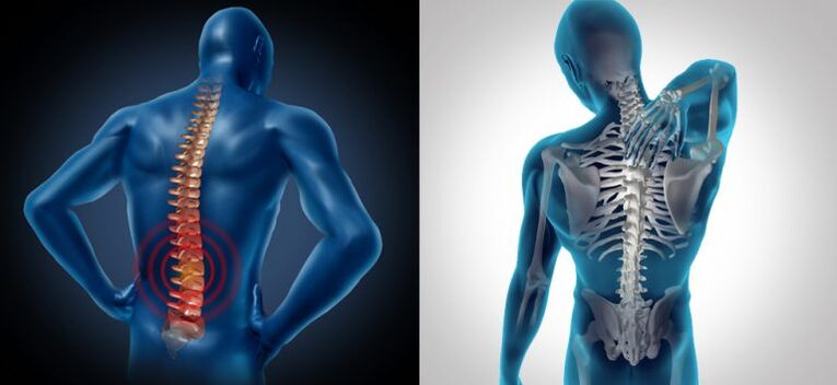 Zápal v spinálnej osteochondróze