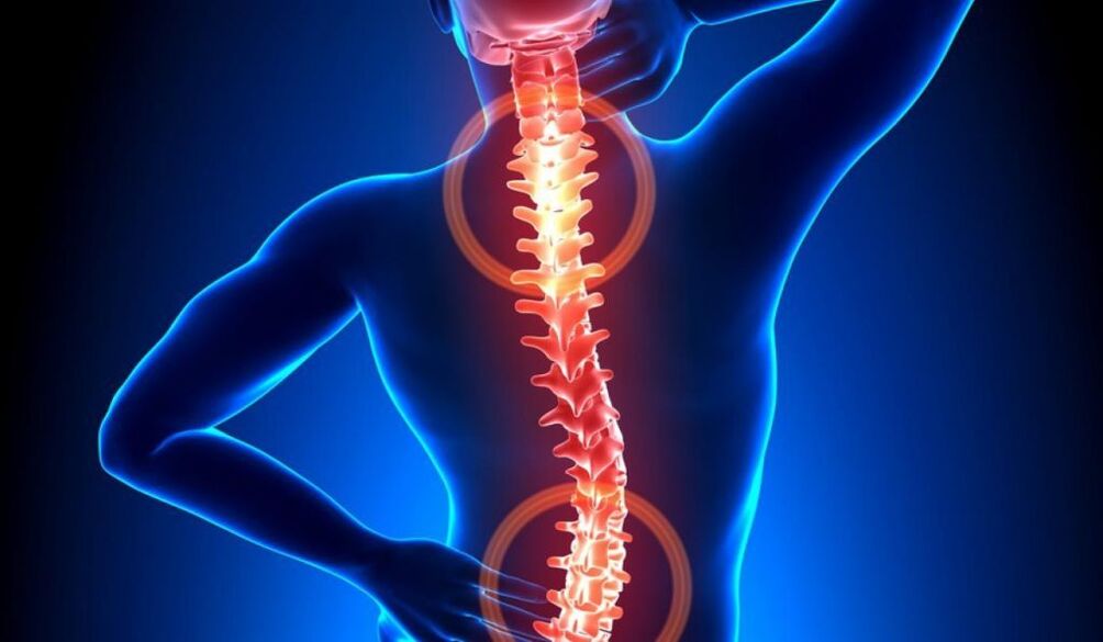 spinálna osteochondróza