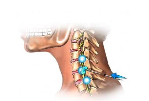 liečba cervikálnej osteochondrózy
